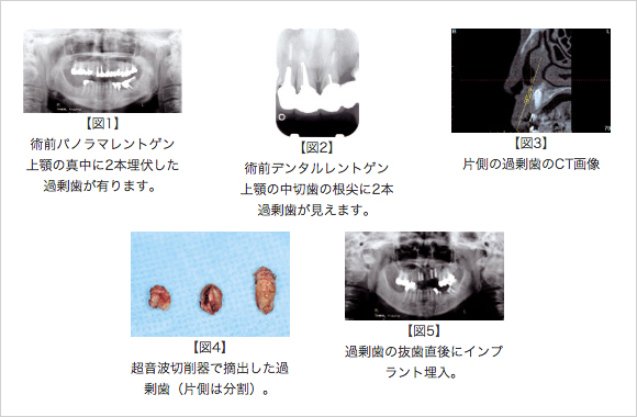 埋伏歯の抜歯と同時にインプラントを埋入でき、同時に骨造成も行える