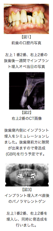 抜歯即時・抜歯早期インプラントの治療例