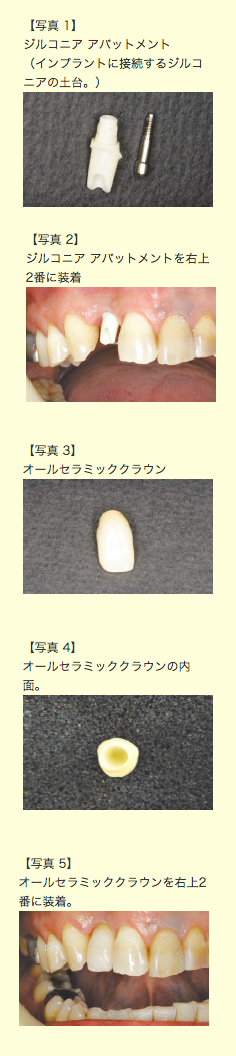 オールセラミッククラウン作成の流れ