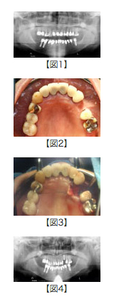 バイコーチカル＆GBR