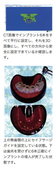 CT画像でインプラント6本をすべて平行に設定し、それを3D画像にし、全ての方向から安全に設定できているか確認します。