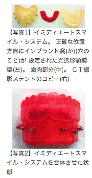 【写真1】イミディエートスマイル・システム。正確な位置方向にインプラント窩(か)(穴のこと)が設定された光造形顎模型(左)。歯肉部分(中)。CT撮影ステントのコピー(右)