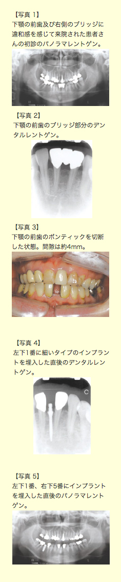 狭い隙間にインプラントかラミネートベニアか矯正か