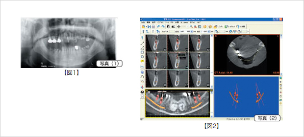 下顎の奥歯のインプラント