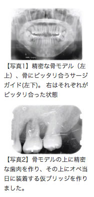 セーフシステム・サージガイド　骨支持タイプ