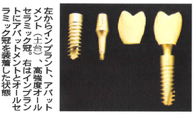左からインプラント、アバットメント（土台）、高強度オールセラミック冠。右はインプラントにアバットメントとオールセラミック冠を装着した状態