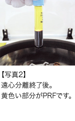 【写真2】遠心分離終了後。黄色い部分がPRFです。