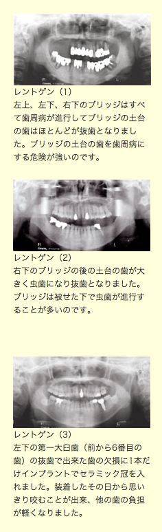 危険なブリッジを止め、インプラントで歯を守りましょう