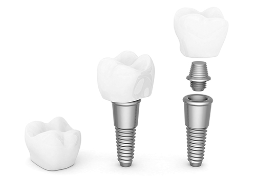 インプラントの種類