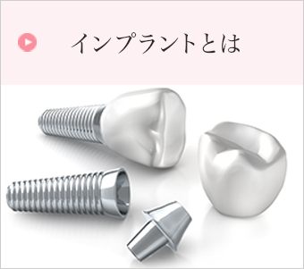 インプラントとは